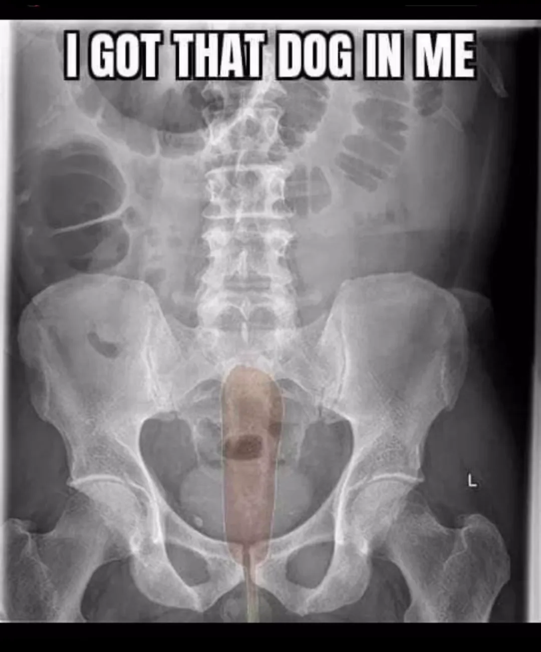 An x-ray image of a human pelvis and spine shows a long, brown, dog-shaped object lodged inside the body, with the overlaid…