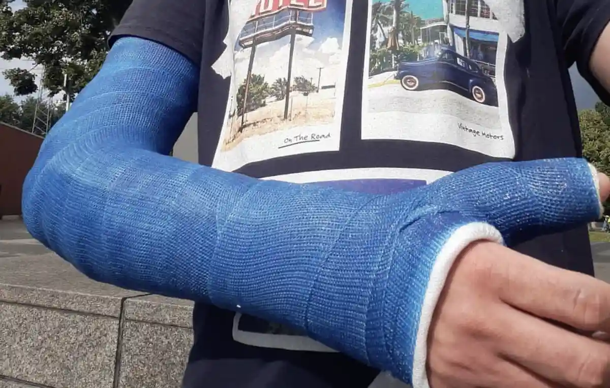 A person wearing a blue arm cast from the elbow to the wrist, with their hand visible at the end. They are wearing a dark…