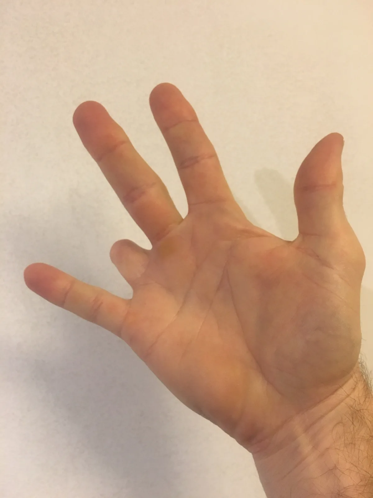 A close-up photo shows a human hand with all five fingers extended against a plain white background. The overlaid text reads…