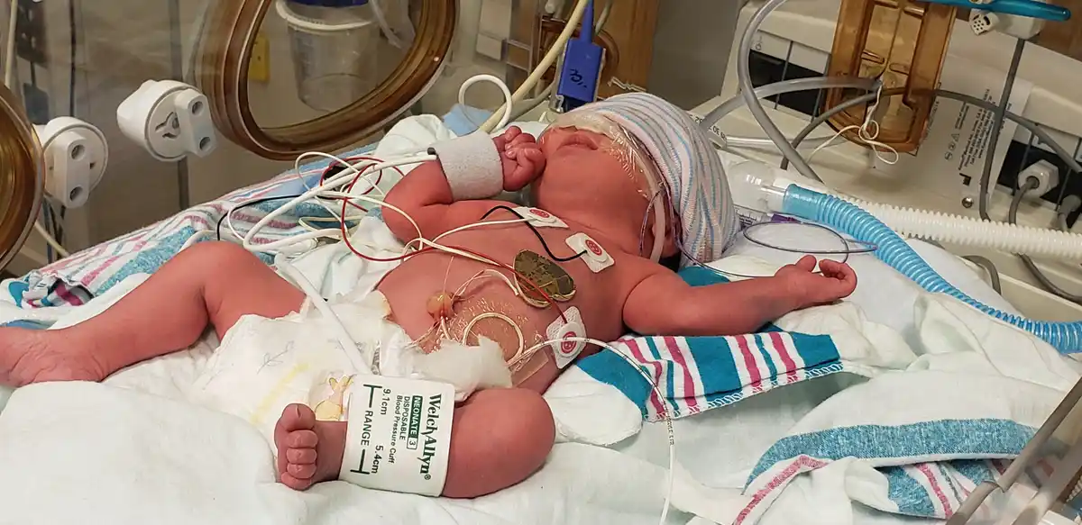 A newborn baby lies in a hospital incubator, heavily connected to medical equipment with wires, sensors, and a blood…