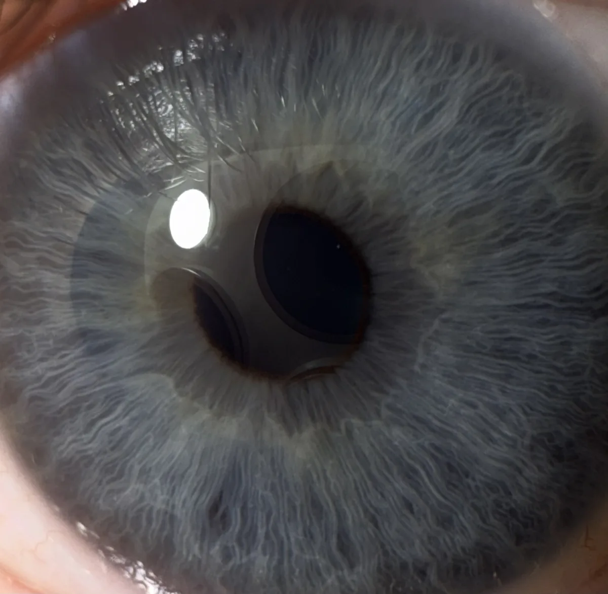 A close-up photo of a human eye with a light blue iris and visible radial patterns, showing a bright reflection of a light…