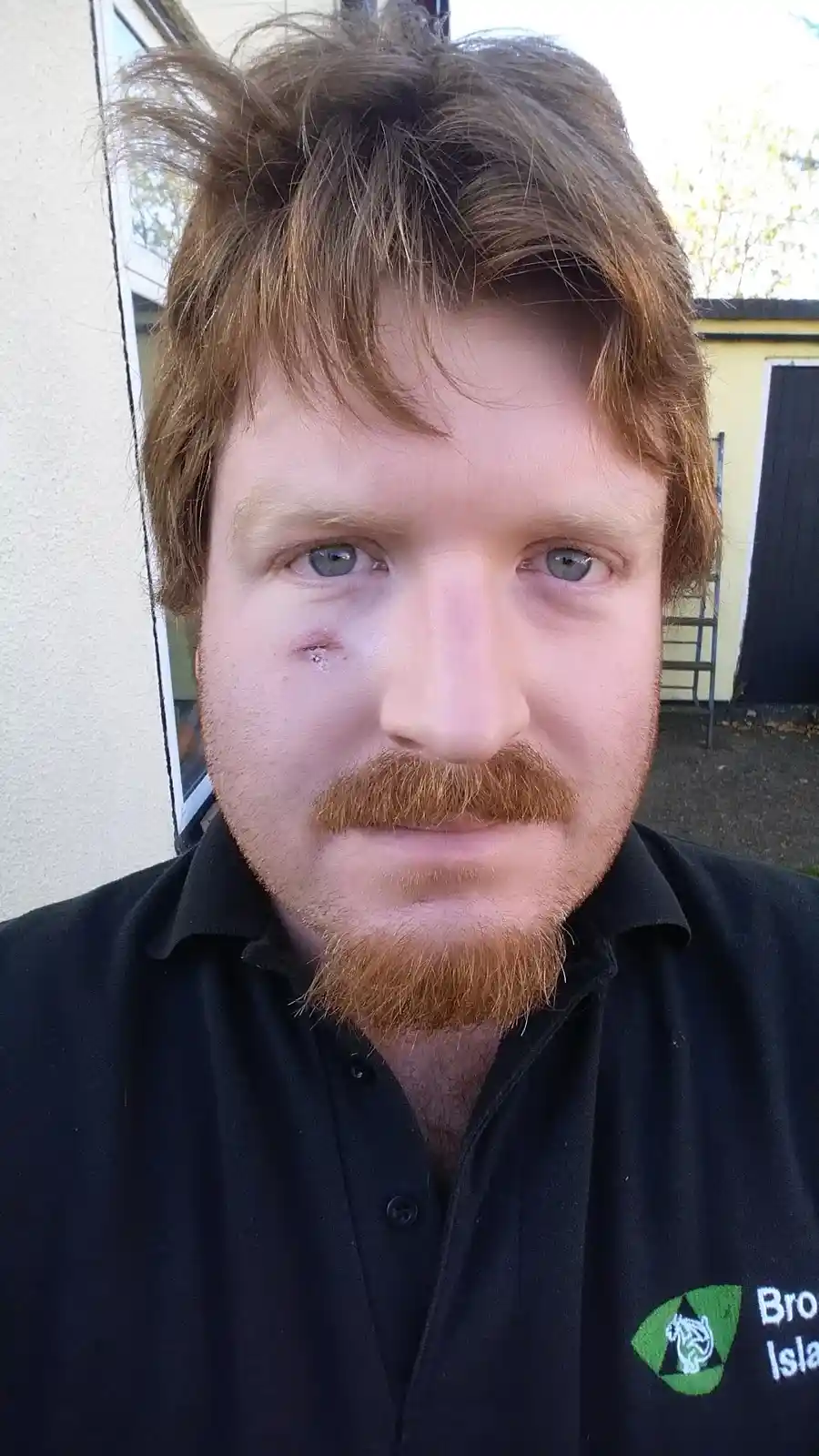 A man with reddish hair, a mustache, and a beard, wearing a black polo shirt with a 'Bro Island' logo, has a visible bruise…