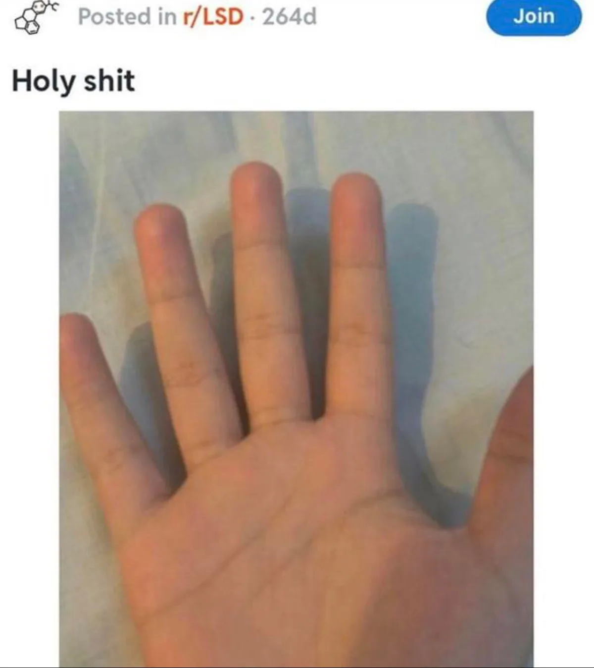 A close-up photo shows a person's open palm with four fingers visible, the thumb is partially cut off on the left side of…