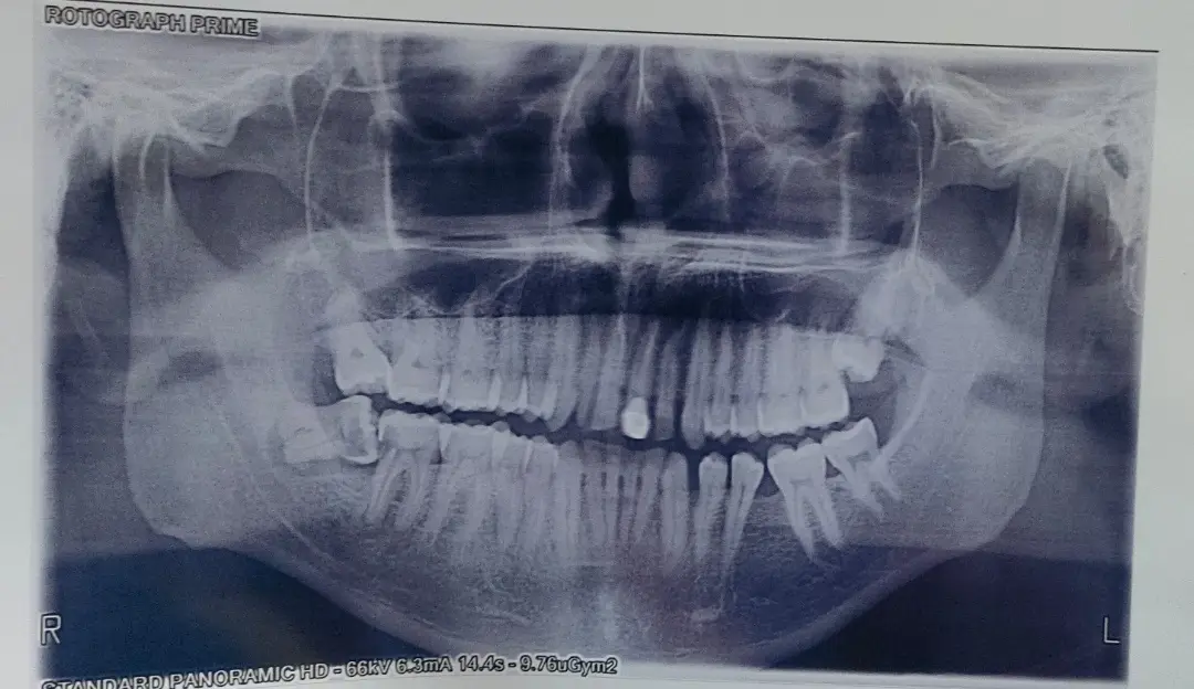 A dental panoramic X-ray showing a full set of teeth with a single, distinct, circular object lodged between the lower front…