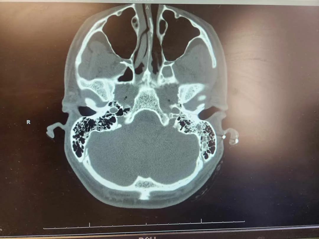 The Intriguing Fracture Line