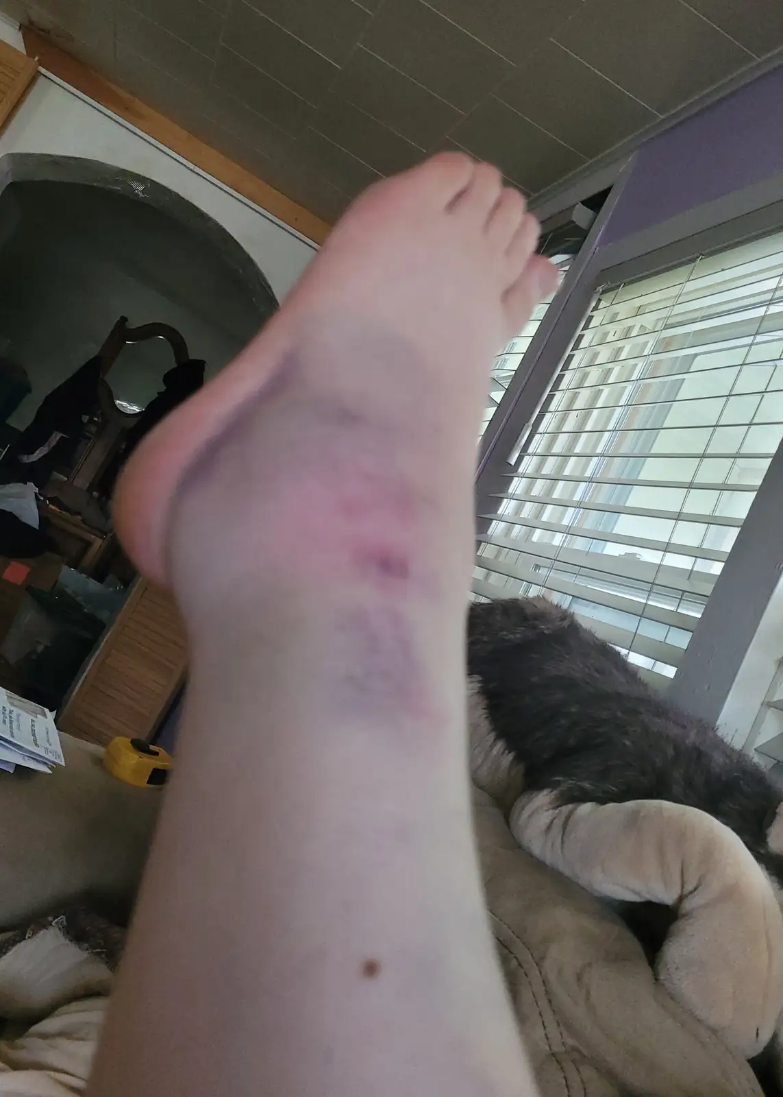 A person holds up their bare foot and ankle to the camera, showing a fresh, reddish-purple scratch mark on the skin. In the…