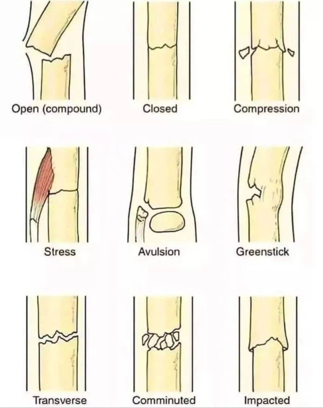 Exploring the Different Types of Fractures